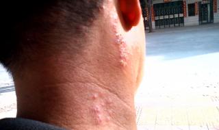 得带状疱疹必定有大病 得带状疱疹必定有大病