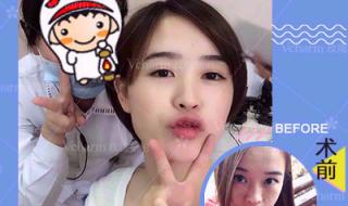 雀斑激光多少钱 雀斑激光多少钱